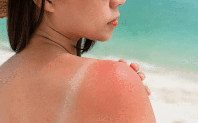 Adiós verano, hola piel radiante: Recomendaciones y cuidados de la piel tras el verano