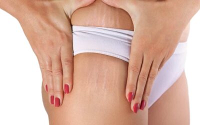 Cómo prevenir y tratar las estrías de forma efectiva