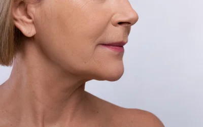 Líneas de marioneta: cómo prevenirlas y tratarlas para rejuvenecer el rostro de forma natural